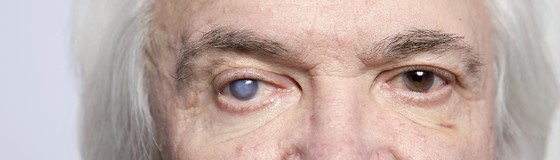 V pokročilejších fázích onemocnění, je již glaukom znát takříkajíc "na první pohled"; zdroj: yavapaihealthandwellness.com